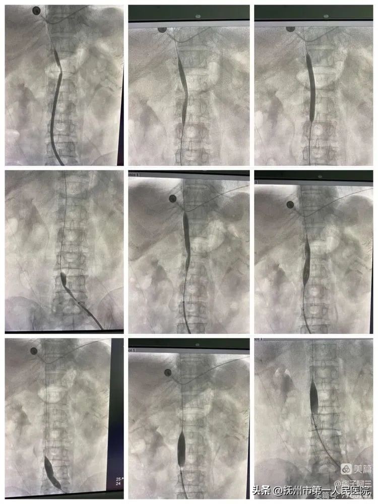 布加氏综合征介入治疗的注意事项,布加综合征介入手术加支架的利弊