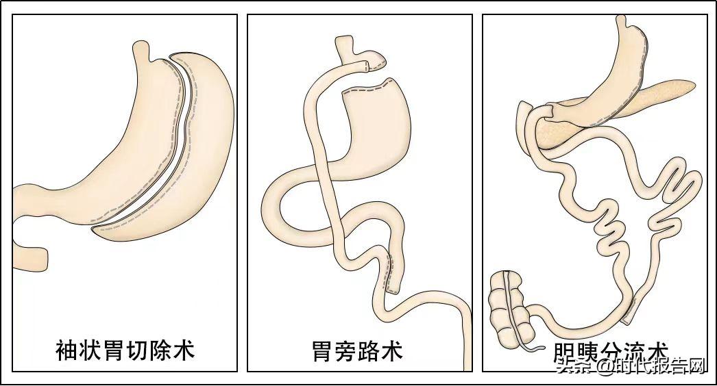 超火的“*肥药减**”司美格鲁肽注射液，所有人都适合吗？
