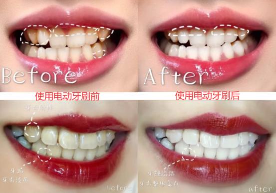 电动牙刷有什么坏处和好处,长期使用电动牙刷的危害弊端
