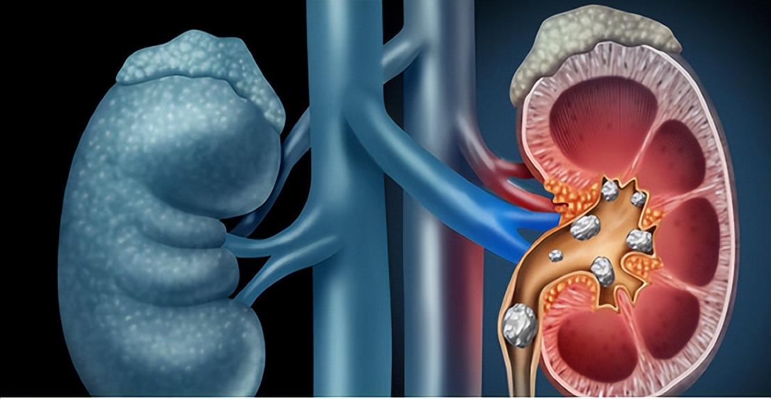 肾结石不能吃鸡蛋吗需要注意什么,肾结石鸡蛋不能吃还能吃什么