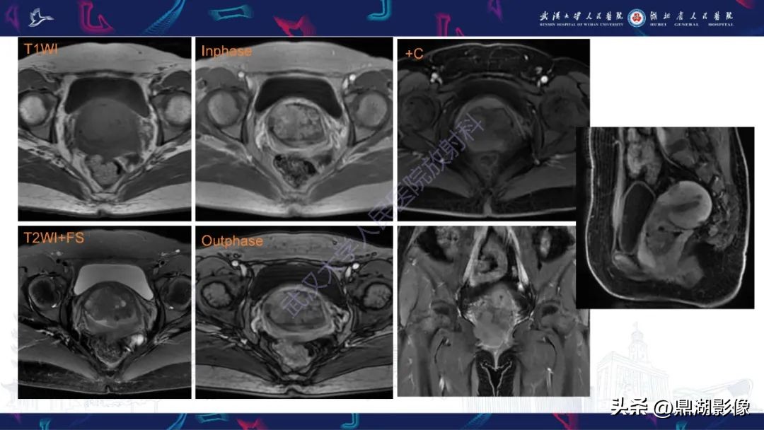 阴道肉瘤的早期症状,阴道里长肉瘤是啥症状