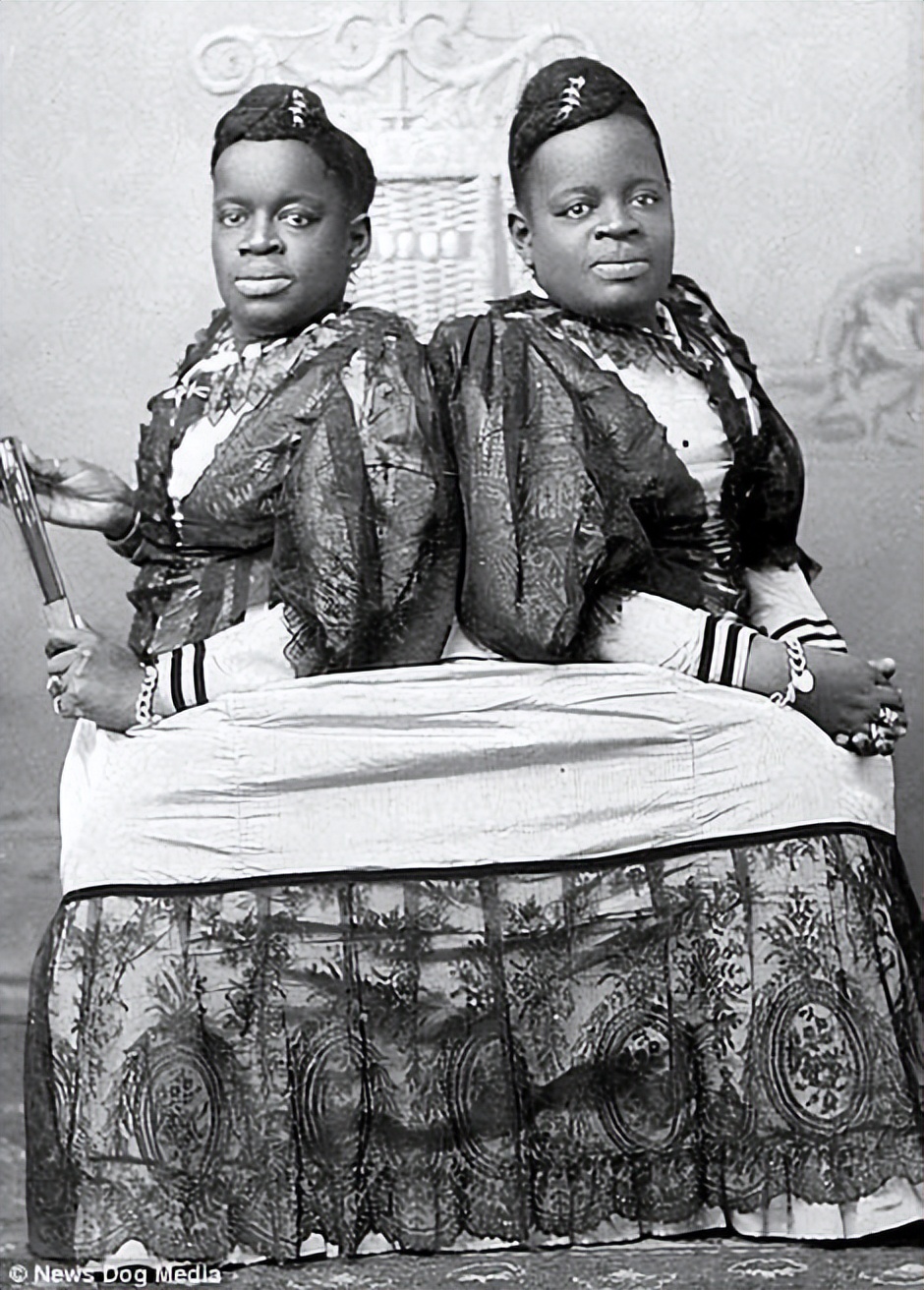 连体双胞胎姐妹的悲惨人生,双胞胎姐妹一个死亡后续