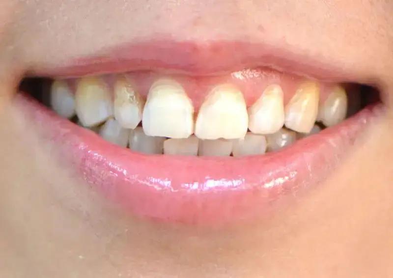 拜拜大黄牙，笑起来更甜