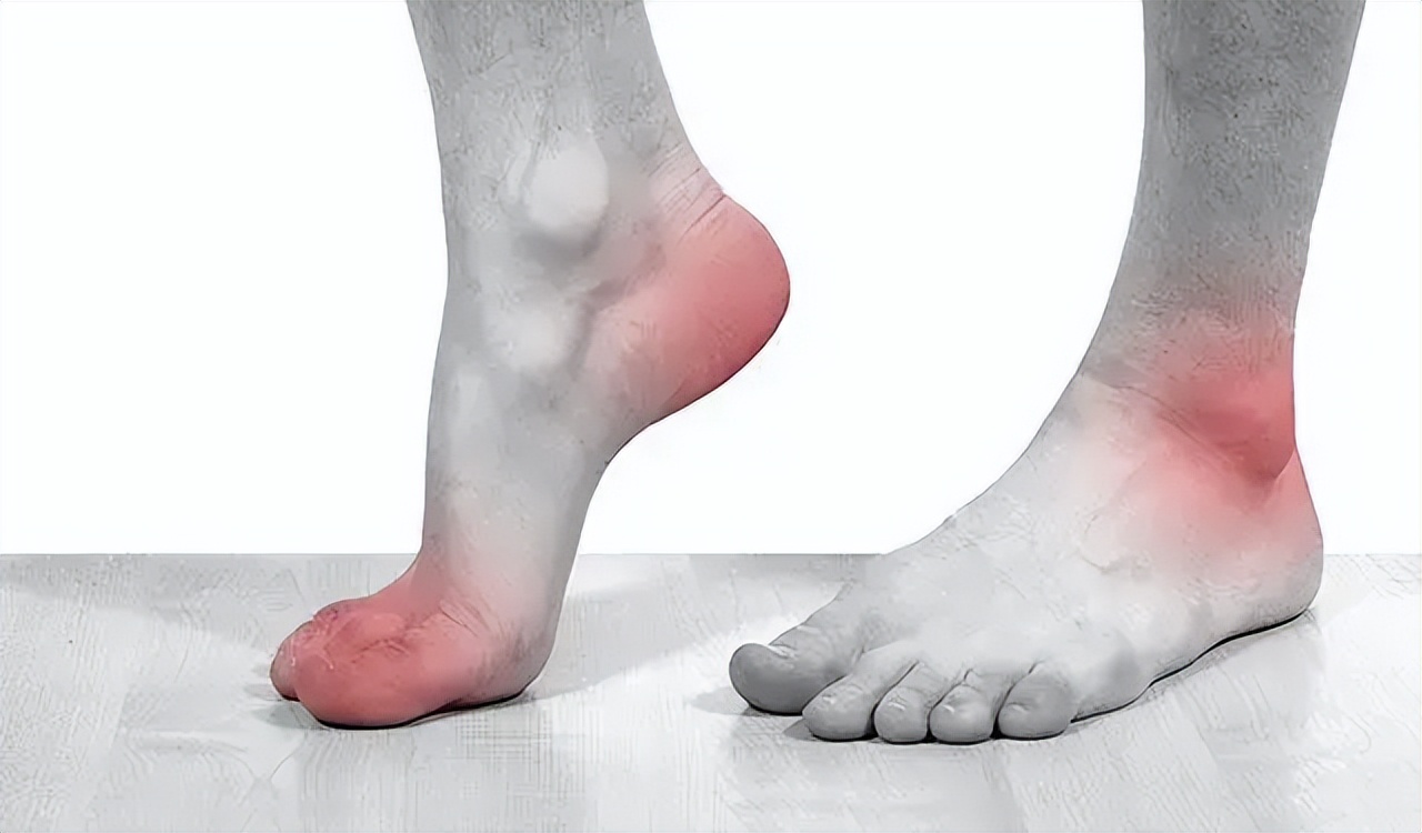 睡觉脚痛是痛风的先兆,睡觉关节受凉痛