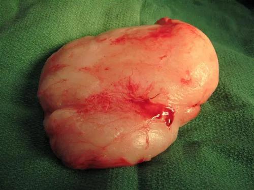 腰部长了一个硬疙瘩像囊肿不疼,腰上长了一个包不痛不痒硬的