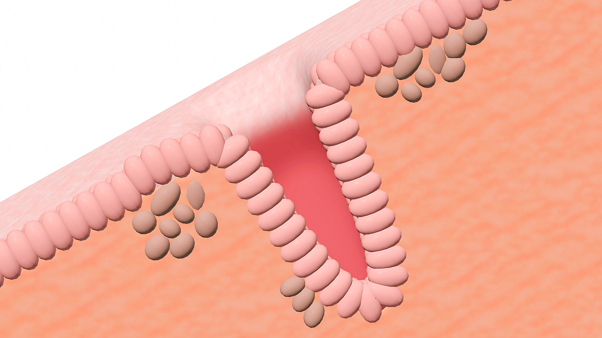 子宫内膜异位症的治疗与管理！2023年度新进展！