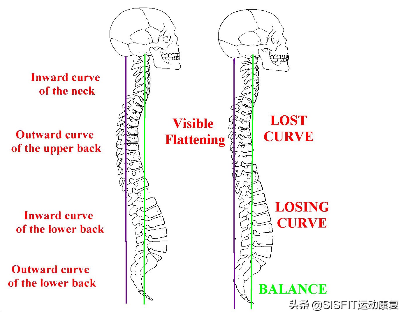 腰椎生理曲度变直可以热敷吗,腰椎生理曲度变直是怎么回事