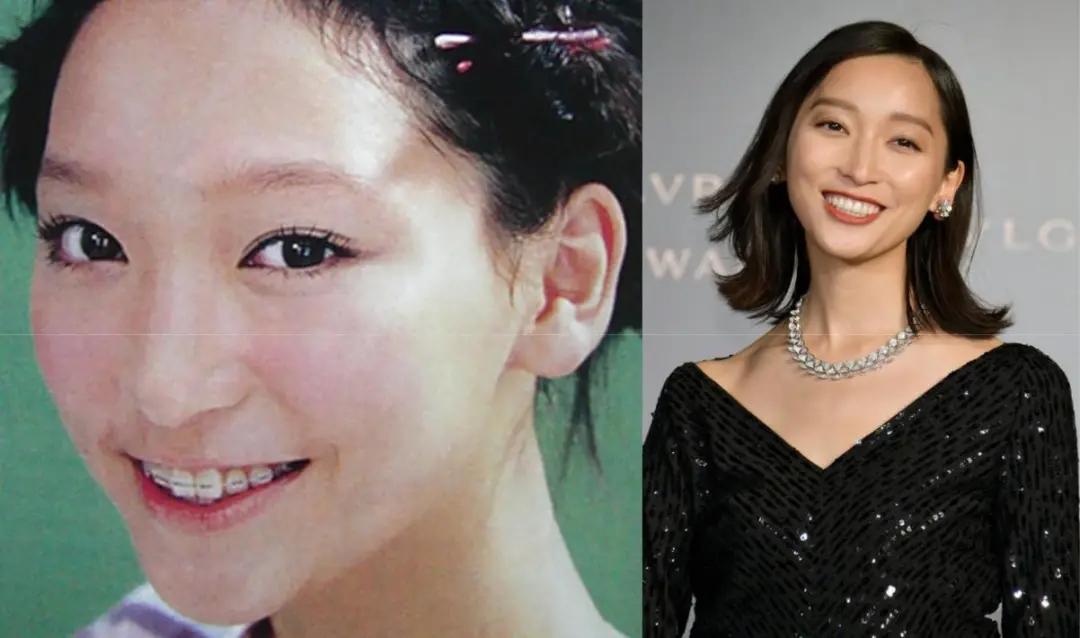 日本整牙的明星,日本整牙明星