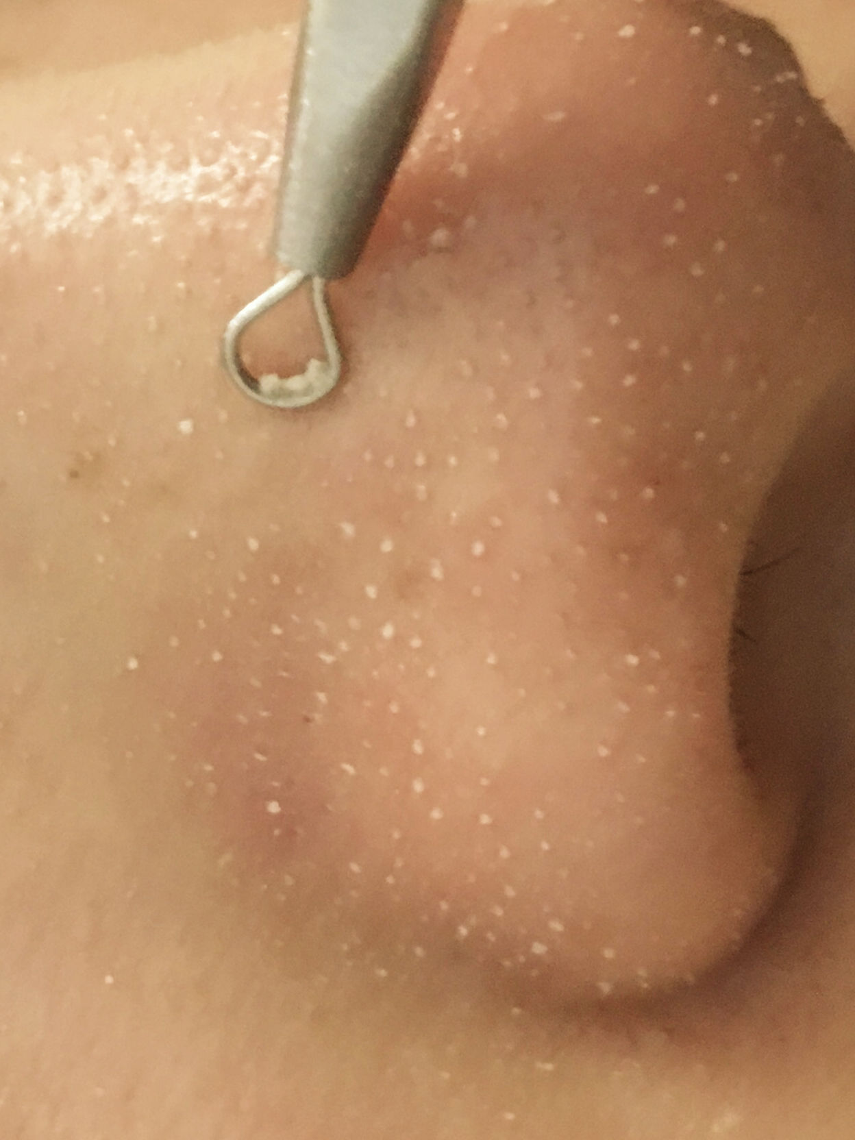 毛孔堵塞怎样才能疏通毛孔,身上毛孔堵塞不出汗怎么疏通毛孔