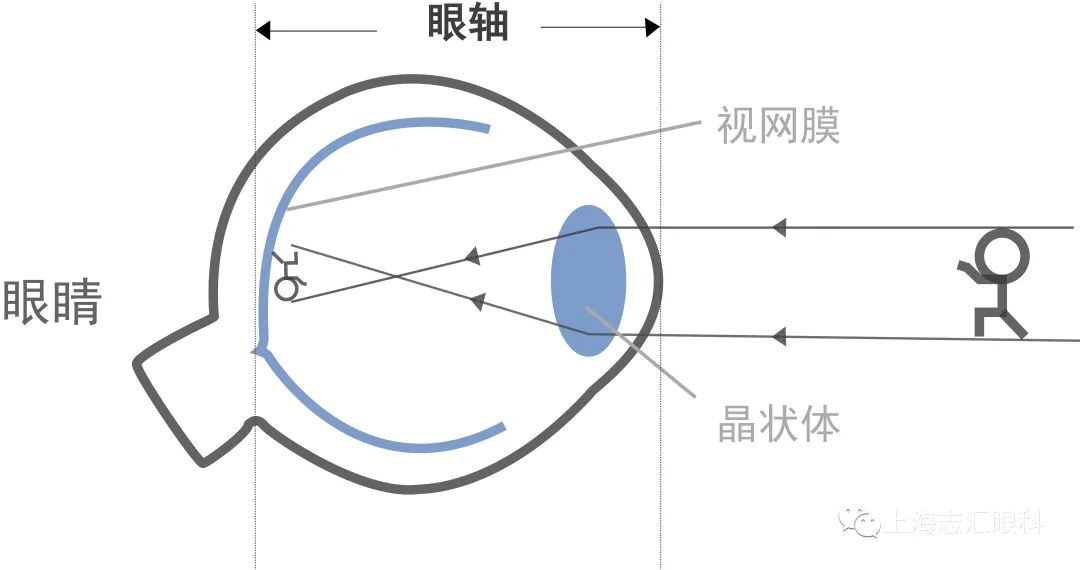 眼轴增长一定是涨度数了吗,成人度数加深眼轴会变吗