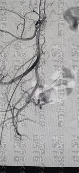 卵巢癌手术费用多少,卵巢癌手术大概需要多少钱