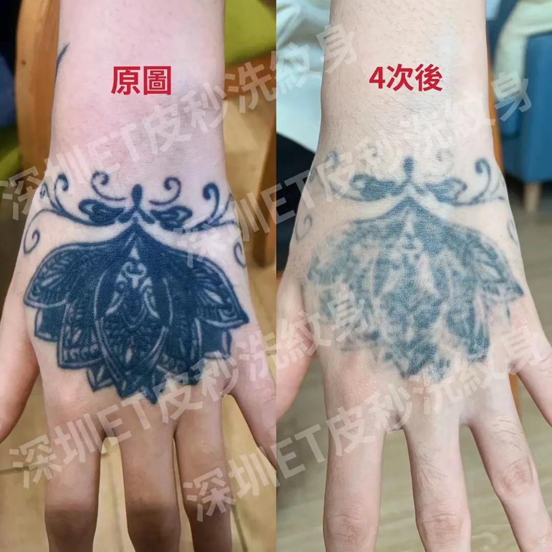 深圳清洗纹身哪家专业,推荐深圳专业洗纹身