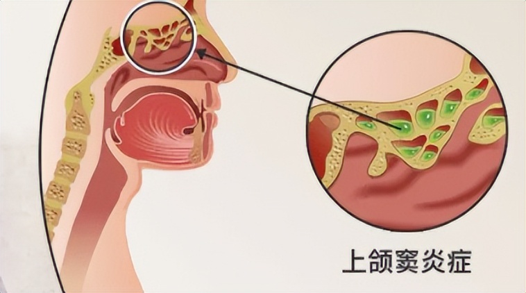 女子牙疼一周,女子牙痛用止痛药