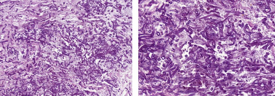 病死率和致死率,病死率20%
