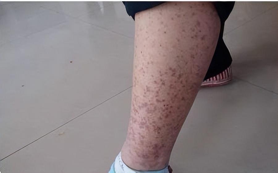 倪海厦治疗紫癜,紫癜如何治疗