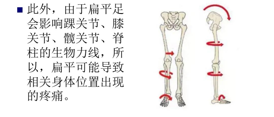 扁平足发病机制,扁平足诊断标准示意图