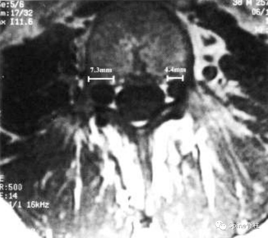 硬膜扩张,duralectasia