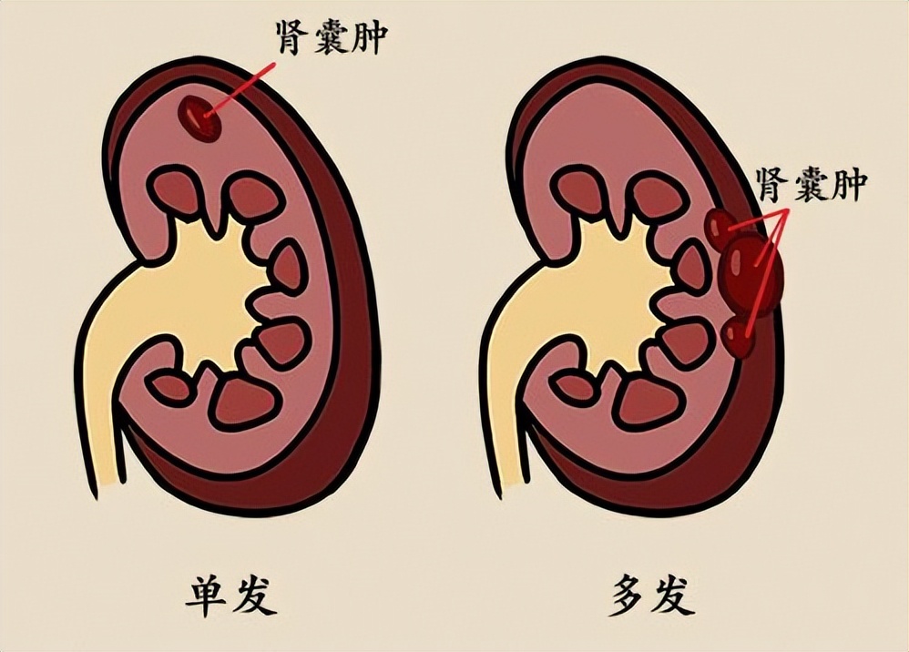 小囊肿怎么消除中医,囊肿用中药调理能治好吗