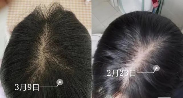 全球最好用的生发液,恶心但真的好用的国货生发液