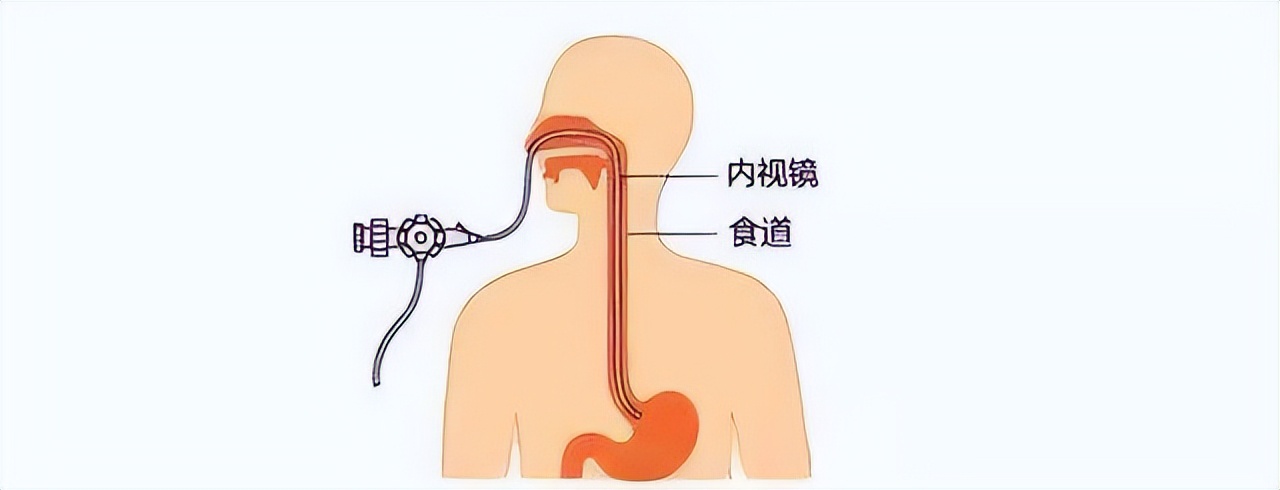 无痛胃镜和普通胃镜有什么区别么,无痛胃镜与普通胃镜的区别有哪些
