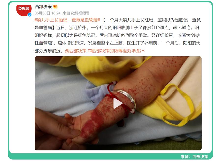宝宝手上长胎记，一查竟是血管瘤！医生：这5种胎记要早处理