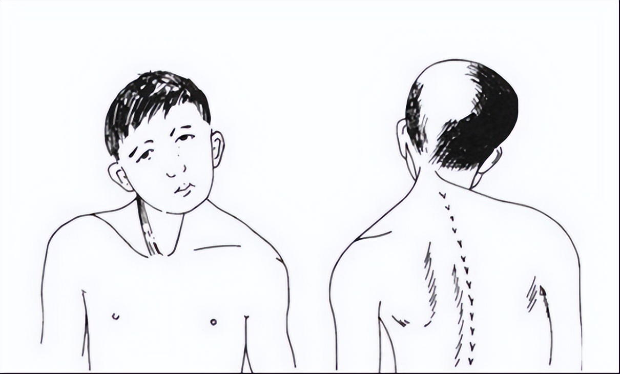 痉挛性斜颈长期治疗没有效果怎么办？