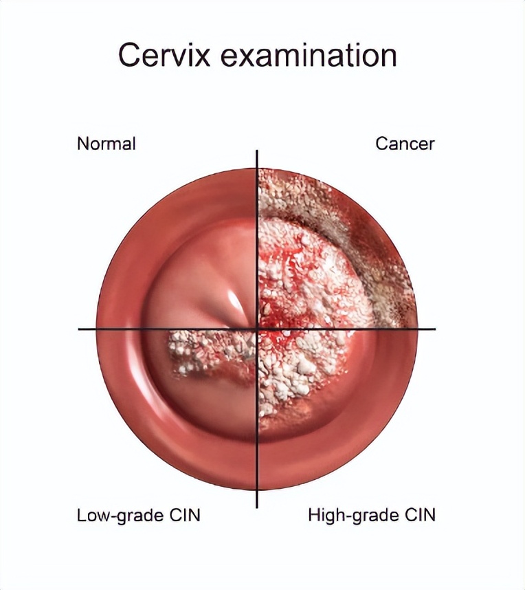hpv疫苗预防哪些癌症,妇科hpv阳性是癌症吗