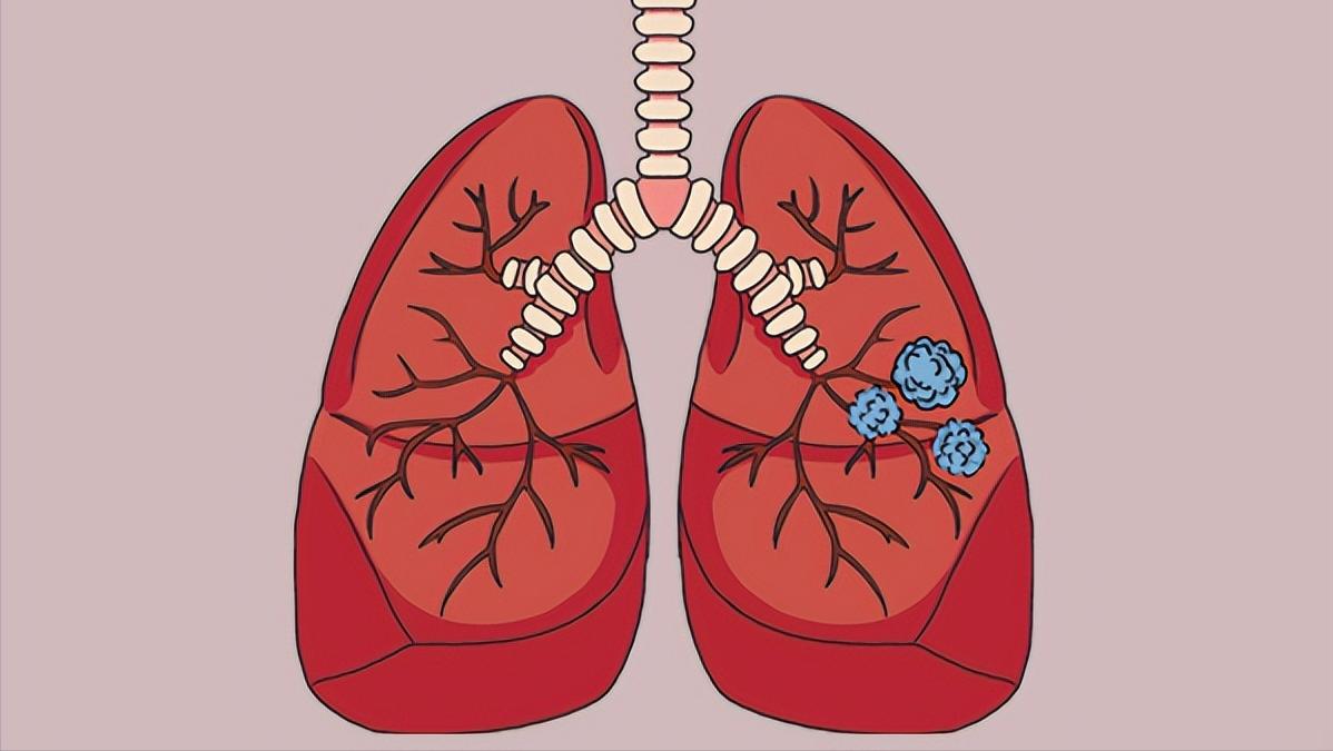 体检查出肺结节可以不调理吗,体检微小肺结节是什么