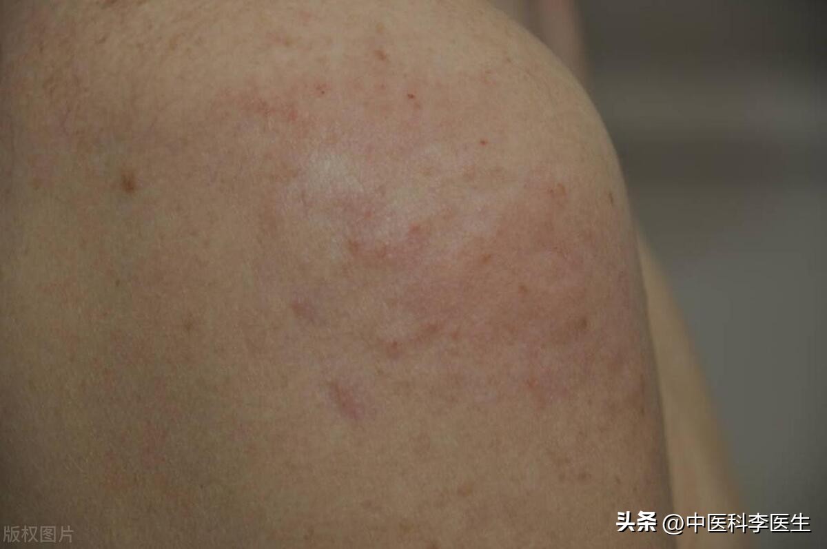 湿疹2000块特效药,治疗湿疹的中药一千多正常吗