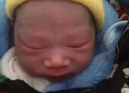 为什么新生儿都是单眼皮,新生儿出生是单眼皮会变双眼皮吗