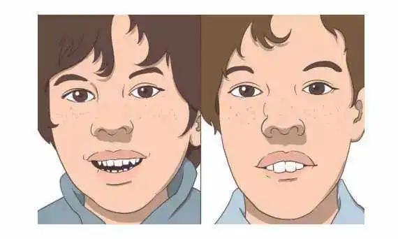 小孩张嘴睡觉腺样体肥大图片,孩子睡觉张嘴呼吸腺样体肥大图片