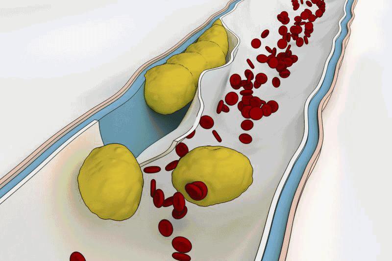 房颤预防最新消息,房颤警惕