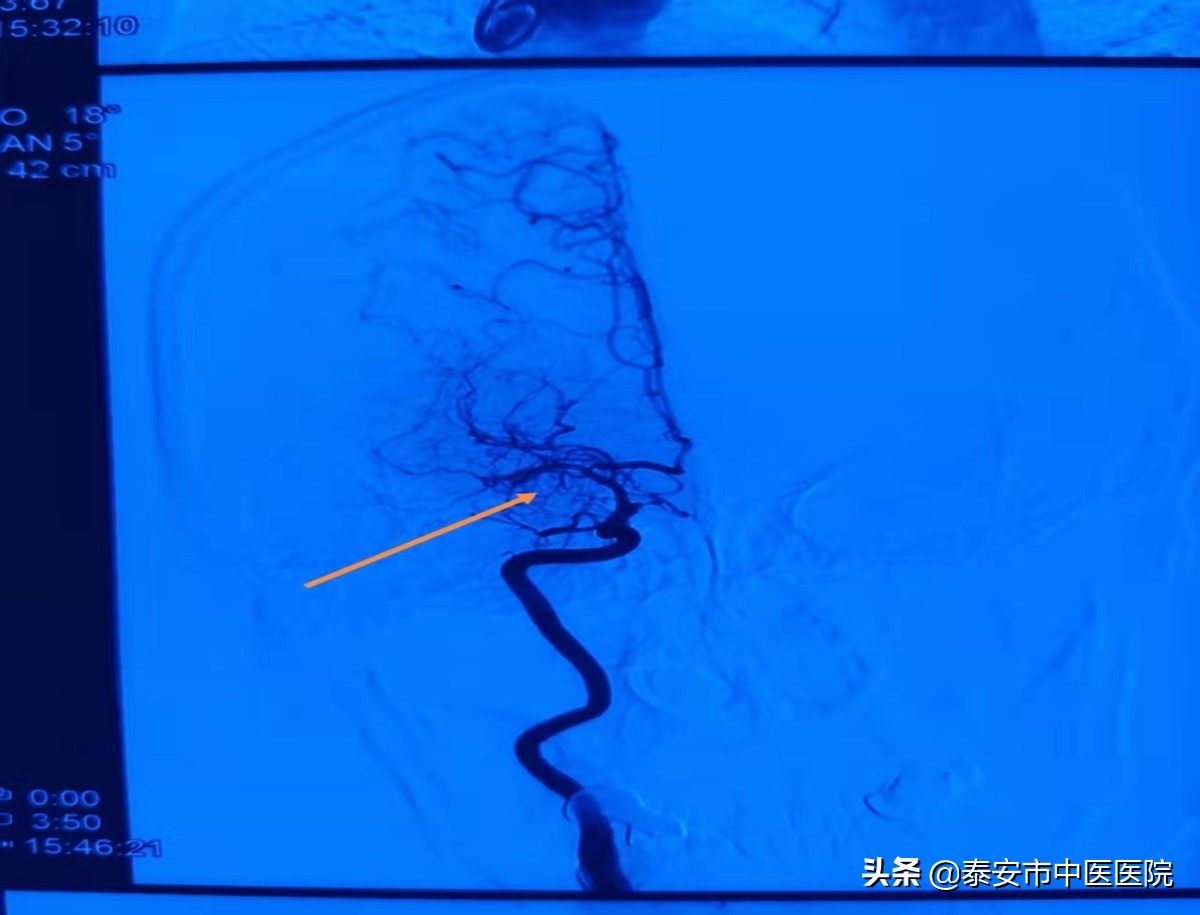 硬核技术!*安泰**市中医医院成功完成本院首例颅内外血管搭桥手术
