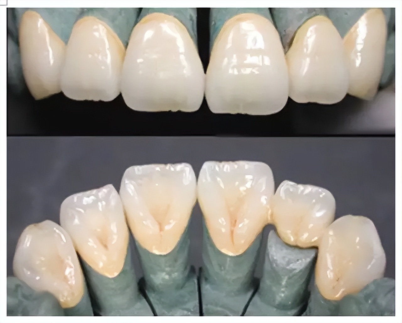 烤瓷牙和全瓷牙价格,烤瓷牙与全瓷牙价格对比