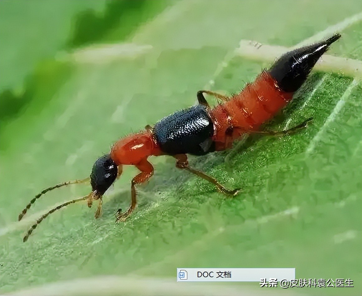 蚊虫叮咬引起的皮炎一年了没好,夏季有哪些虫叮咬会红肿
