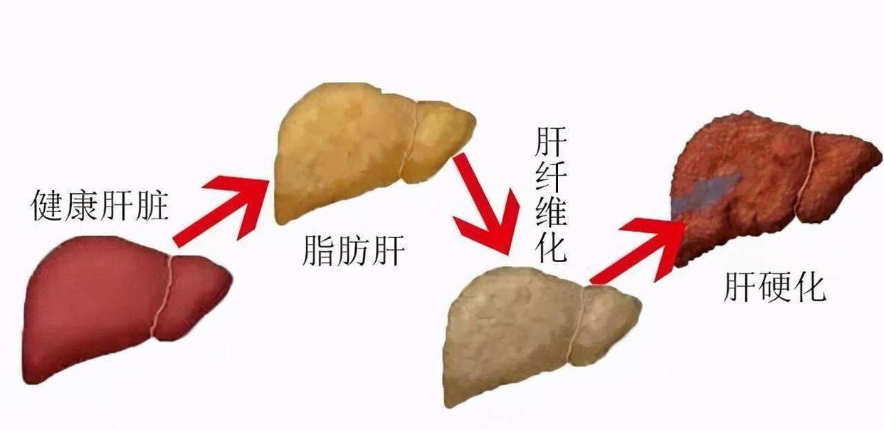 体检肝功能转氨酶偏高怎么快速降,转氨酶偏高怎么样能让体检通过呢