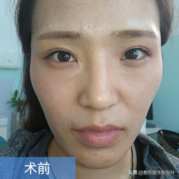 脸部脂肪填充怎样才有立体感,面部脂肪填充后会变的更幼态