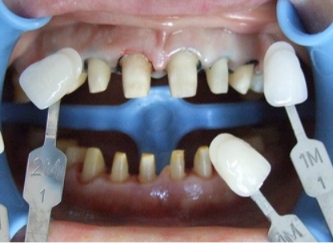 美恒牙齿矫正怎么样,美牙科普小知识