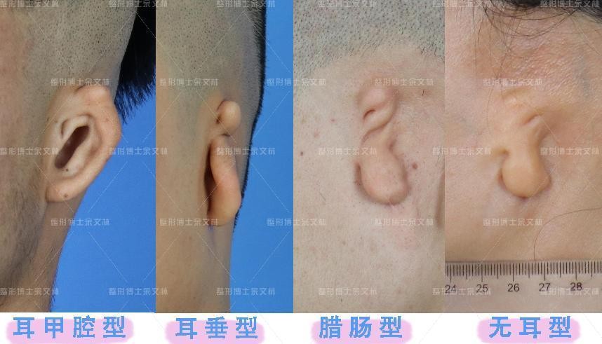 小耳畸形手术做了恢复图片,耳软骨超肋一定要搭支架吗