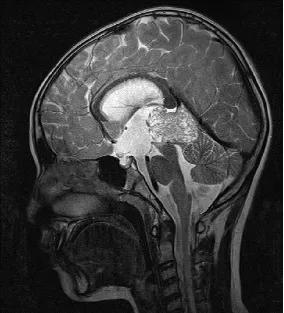松果体肿瘤的护理措施,松果体肿瘤怎么治疗