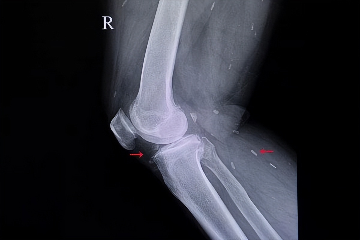 补钙以后的表现,钙化与补钙有关系吗