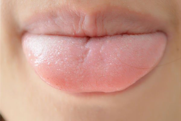 孩子舌头发白中间裂纹怎么调理,舌头两边有齿痕舌苔发白有裂纹