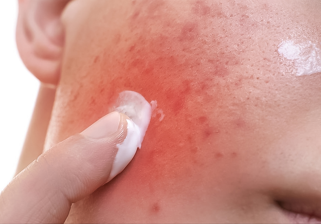 清粉刺疼不疼,清粉刺后红肿什么时候消