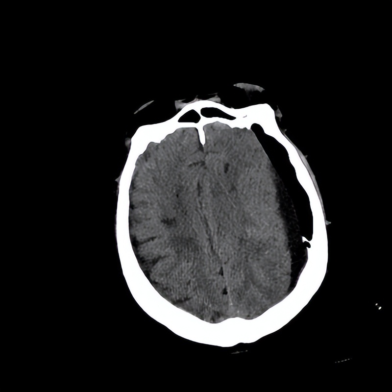 老人摔倒致硬膜下血肿哈医大一院神外梁洪生20分钟快速清除！