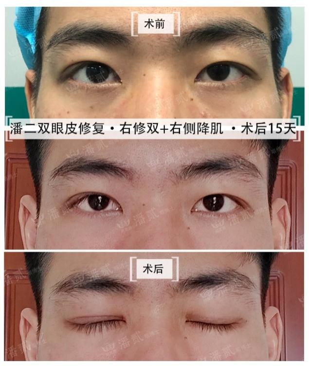 男士割双眼皮恢复全过程,男士割双眼皮手术