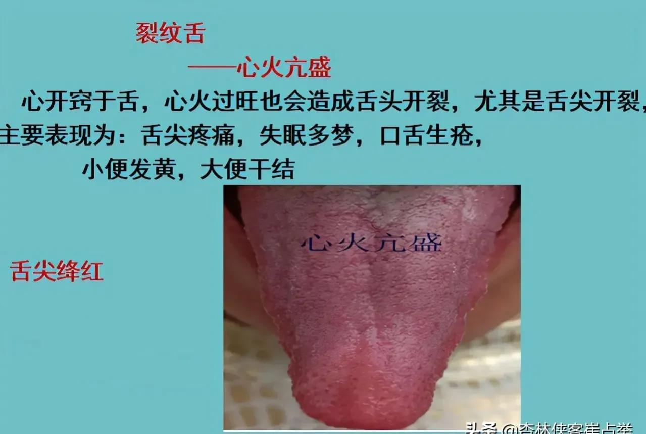 阴虚裂纹舌怎么调理,裂纹舌调理的经历