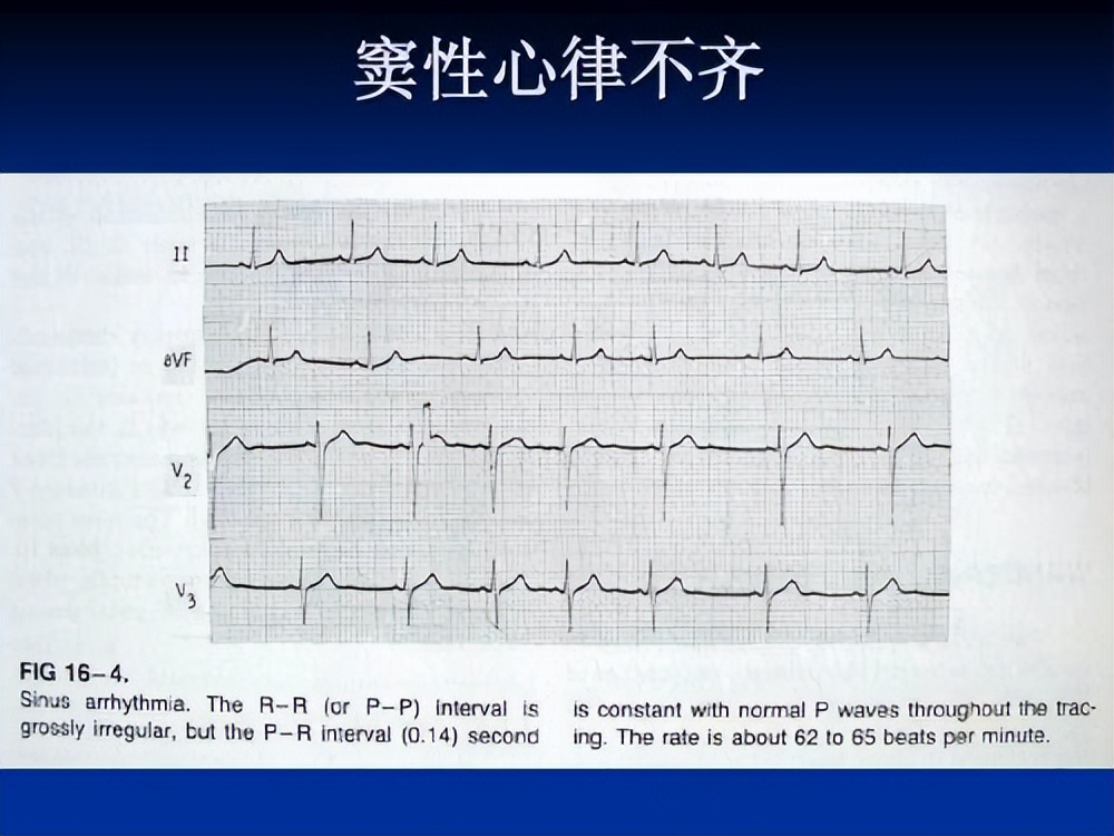 心脏心律不齐是什么原因引起的,心律不齐是心脏病吗吃什么药治