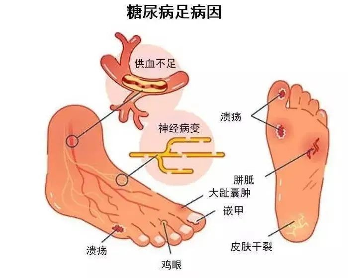 糖尿病足居家注意事项,糖尿病足病防治成功案例分享