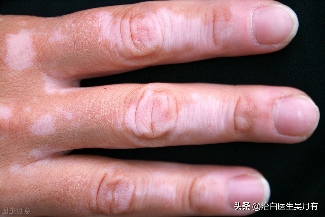 关于光疗祛白斑，你所关心的问题都在这！很全，建议收藏