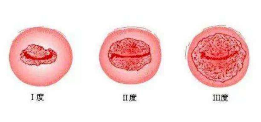 宫颈糜烂和生活作风有关吗,宫颈糜烂是不注意卫生得的吗